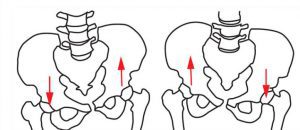 Lateral pelvic tilt