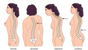 different types of poor posturedifferent types of poor posture