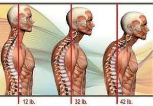 How Long Does It Take to Correct Forward Head Posture
